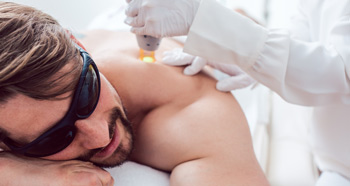Man getting laser hair removal on his shoulders